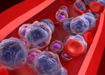 Alertan sobre un tipo de cáncer sanguíneo difícil de detectar con síntomas engañosos